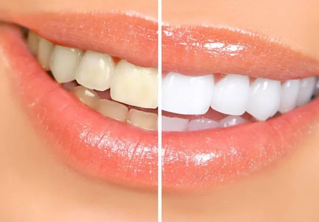 Natural Tooth Whitening: Does it Work