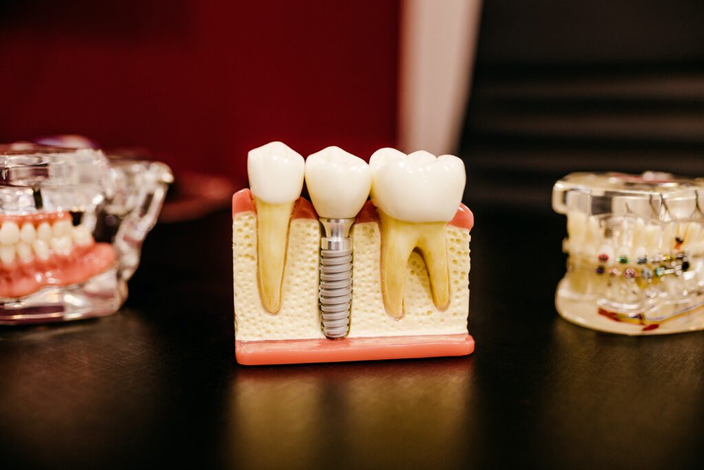 ed lowe implant july 26 The Lowe Centre Sensitive Teeth Solutions
