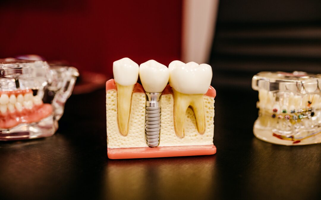 The Benefits of Dental Implants